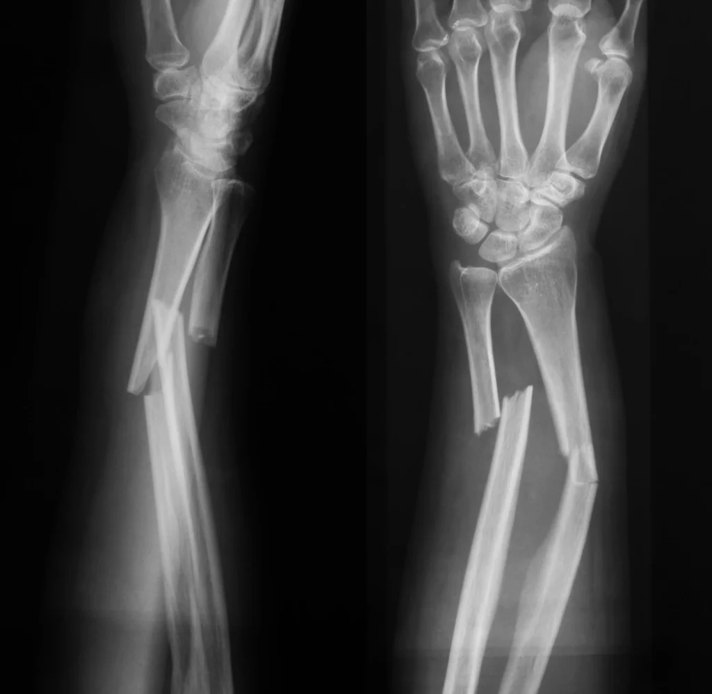 X ray of broken arm bones. 