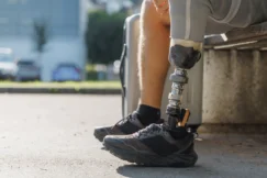Why Amputation Cases Are Different from Other Injury Claims